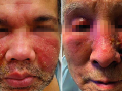 Вакцина от COVID привела к образованию гнойных шишек у мужчин в США