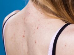 Ученые назвали симптом омикрон-штамма COIVD, заметный на коже