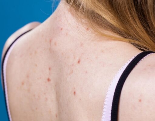 Ученые назвали симптом омикрон-штамма COIVD, заметный на коже