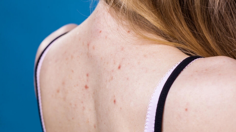 Ученые назвали симптом омикрон-штамма COIVD, заметный на коже